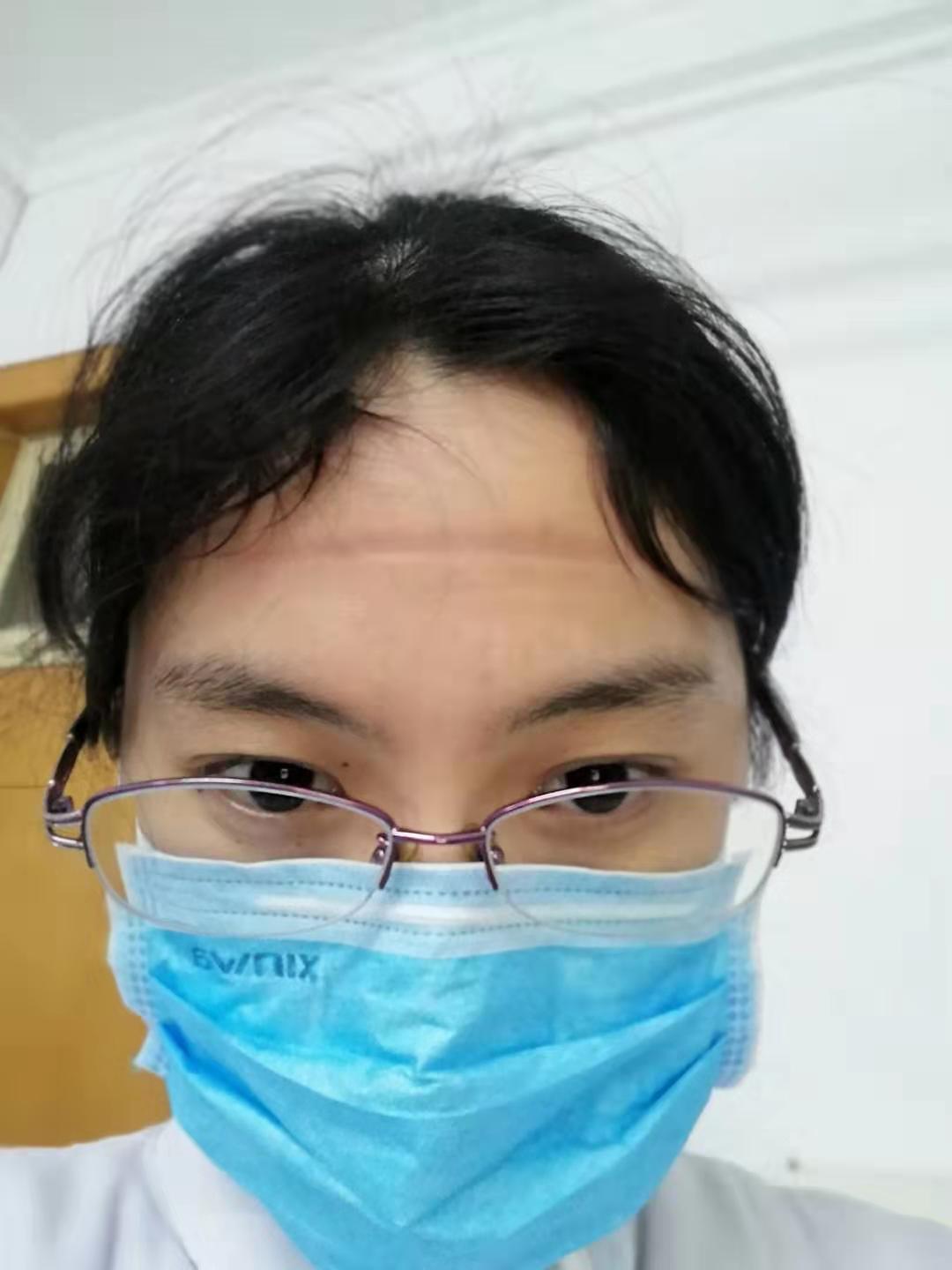 发热门诊值班护士,戴护目镜6个多小时压在额头上的痕迹.jpg 发热门诊值班护士,戴护目镜6个多小时压在额头上的痕迹.jpg